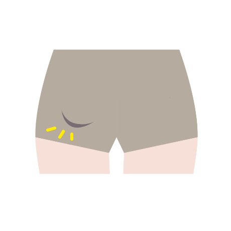 太ももの付け根(股)に、柔らかい膨らみが出てくる